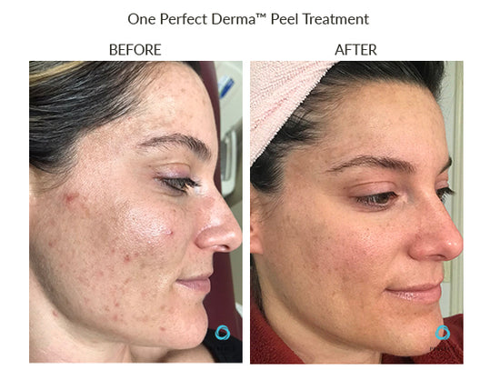 Before And After The Perfect Dermapeel Treatement – The Perfect Derma Peel