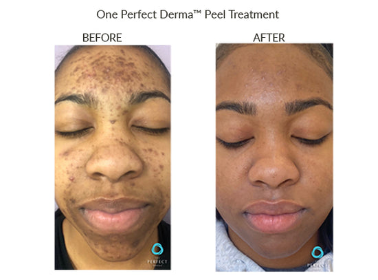 Before And After The Perfect Dermapeel Treatement – The Perfect Derma Peel