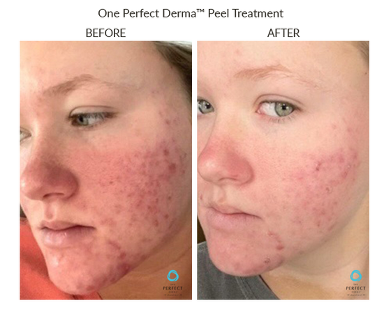 Before And After The Perfect Dermapeel Treatement – The Perfect Derma Peel