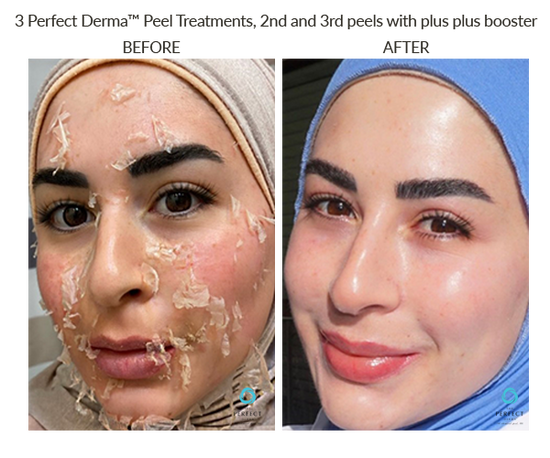 Before And After The Perfect Dermapeel Treatement The Perfect Derma Peel Before And After The Perfect Dermapeel Treatement The Perfect Derma Peel