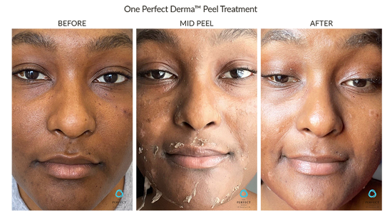 Before And After The Perfect Dermapeel Treatement The Perfect Derma Peel Before And After The Perfect Dermapeel Treatement The Perfect Derma Peel